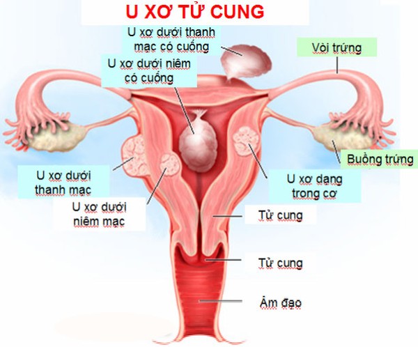 Có chút bất thường về nguyệt san, tôi không hề nghĩ mình bị u xơ tử cung - Ảnh 3.