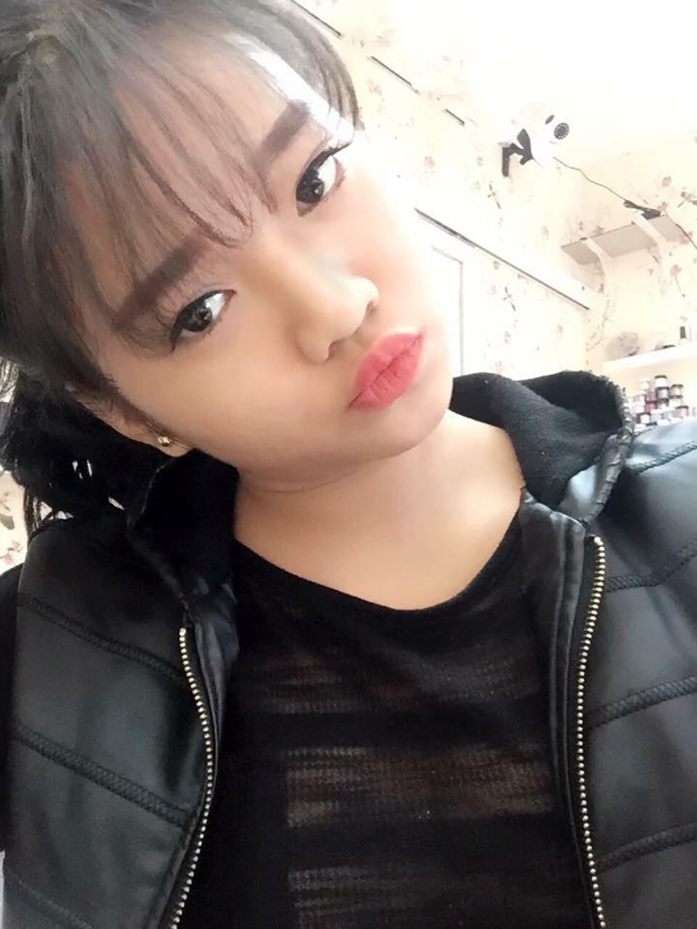 Muốn làm duyên bằng má lúm đồng tiền nhân tạo, cô gái trẻ bị áp-xe, má sưng như quả trứng - Ảnh 1. Muốn làm duyên bằng má lúm đồng tiền nhân tạo, cô gái trẻ bị áp-xe, má sưng như quả trứng - Ảnh 1.