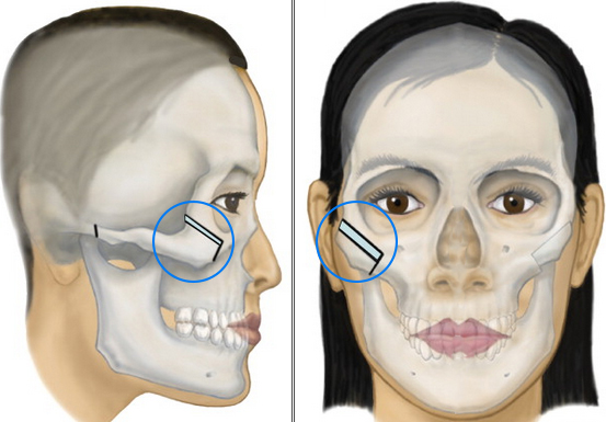 Sau phương pháp gọt cằm, phái đẹp lại chọn cách hạ gò má để mặt thon gọn hơn - Ảnh 2.