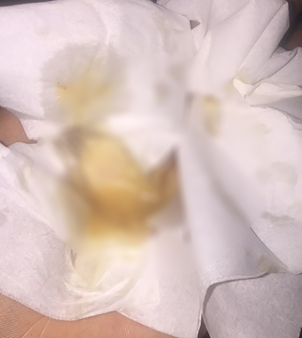 Muốn làm duyên bằng má lúm đồng tiền nhân tạo, cô gái trẻ bị áp-xe, má sưng như quả trứng - Ảnh 8. Muốn làm duyên bằng má lúm đồng tiền nhân tạo, cô gái trẻ bị áp-xe, má sưng như quả trứng - Ảnh 8.