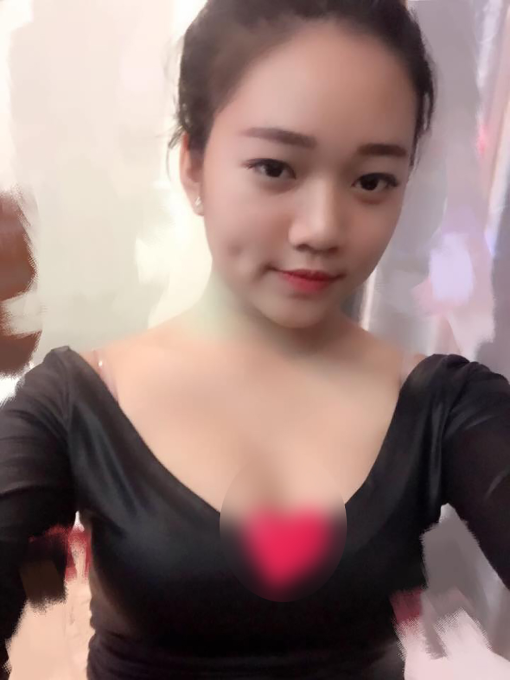 Muốn làm duyên bằng má lúm đồng tiền nhân tạo, cô gái trẻ bị áp-xe, má sưng như quả trứng - Ảnh 3. Muốn làm duyên bằng má lúm đồng tiền nhân tạo, cô gái trẻ bị áp-xe, má sưng như quả trứng - Ảnh 3.