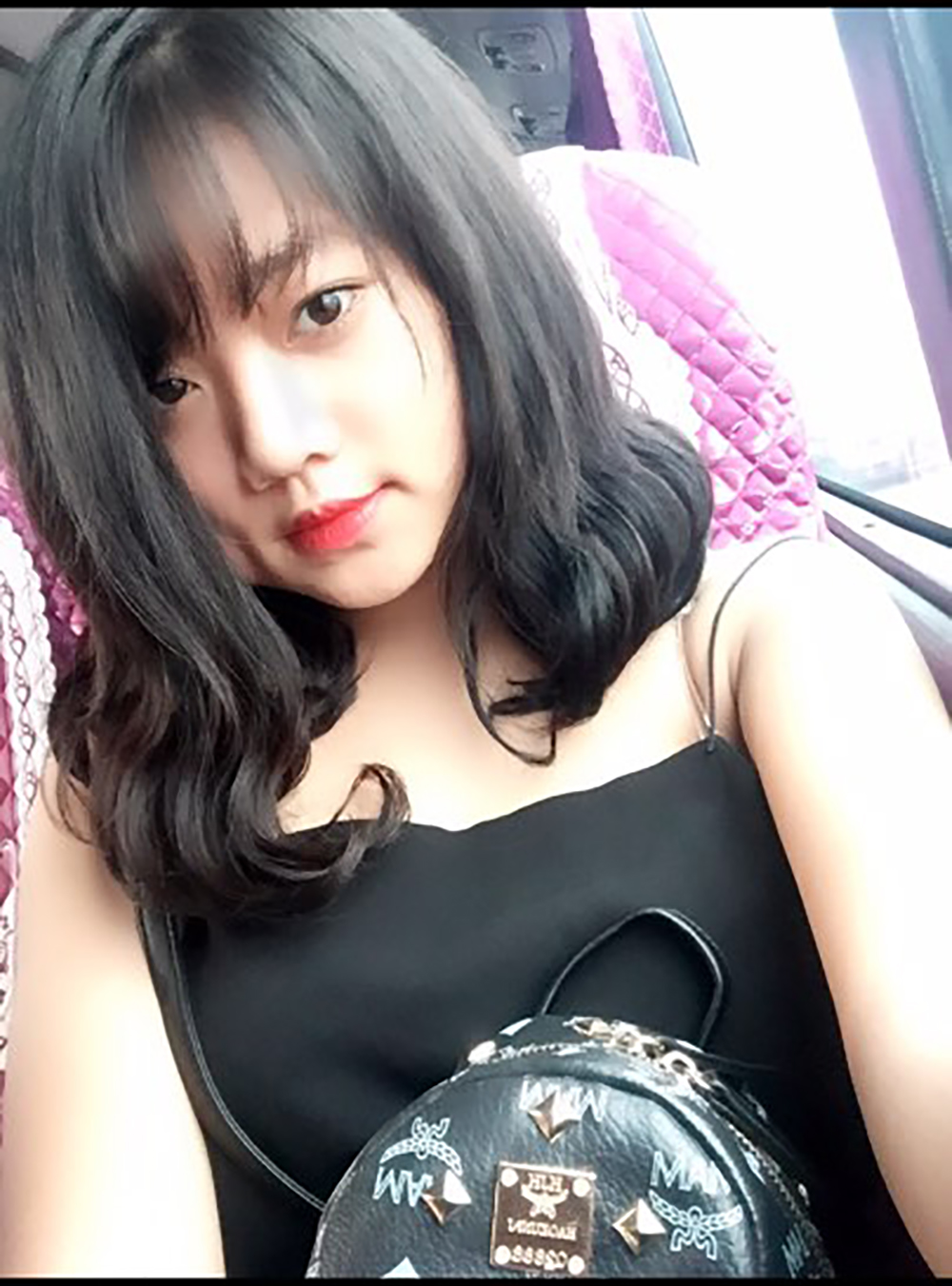 Muốn làm duyên bằng má lúm đồng tiền nhân tạo, cô gái trẻ bị áp-xe, má sưng như quả trứng - Ảnh 5. Muốn làm duyên bằng má lúm đồng tiền nhân tạo, cô gái trẻ bị áp-xe, má sưng như quả trứng - Ảnh 5.