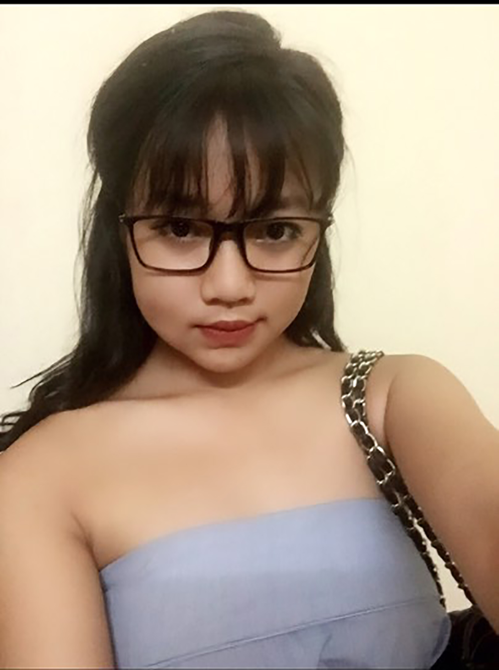 Muốn làm duyên bằng má lúm đồng tiền nhân tạo, cô gái trẻ bị áp-xe, má sưng như quả trứng - Ảnh 4. Muốn làm duyên bằng má lúm đồng tiền nhân tạo, cô gái trẻ bị áp-xe, má sưng như quả trứng - Ảnh 4.