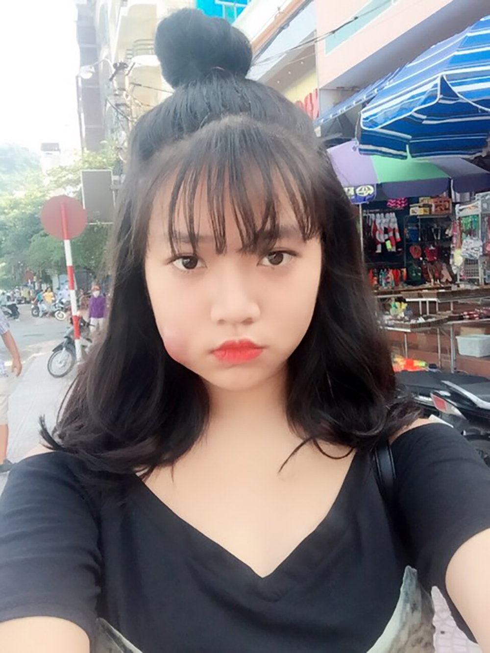 Muốn làm duyên bằng má lúm đồng tiền nhân tạo, cô gái trẻ bị áp-xe, má sưng như quả trứng - Ảnh 6. Muốn làm duyên bằng má lúm đồng tiền nhân tạo, cô gái trẻ bị áp-xe, má sưng như quả trứng - Ảnh 6.