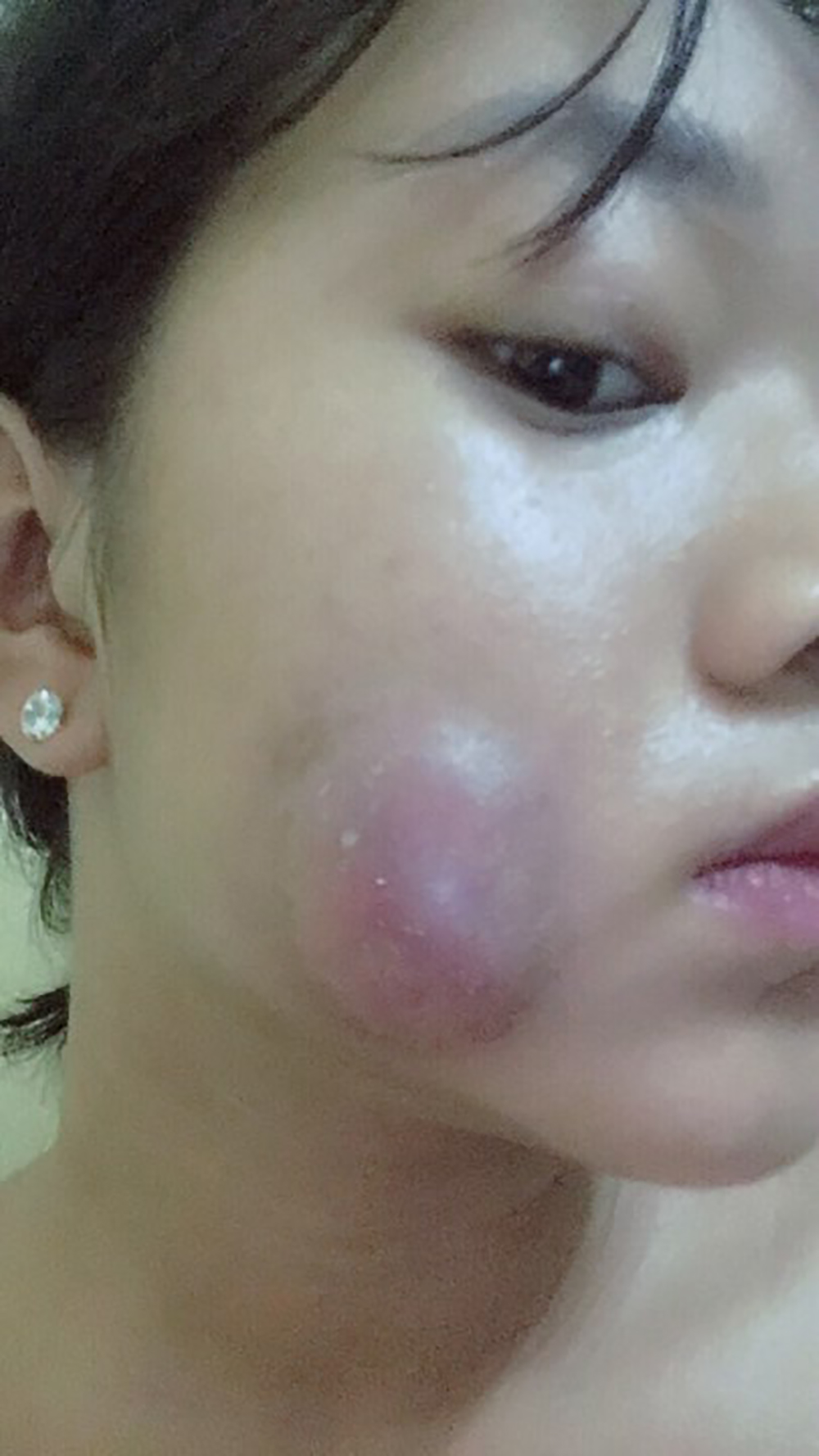 Muốn làm duyên bằng má lúm đồng tiền nhân tạo, cô gái trẻ bị áp-xe, má sưng như quả trứng - Ảnh 7. Muốn làm duyên bằng má lúm đồng tiền nhân tạo, cô gái trẻ bị áp-xe, má sưng như quả trứng - Ảnh 7.