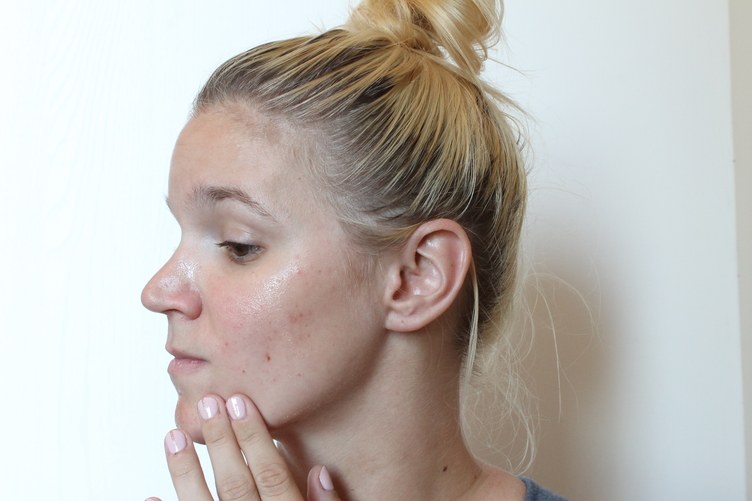 Cô nàng dùng thử loại gel dán mụn thần thánh suốt thời gian qua và đây là kết quả - Ảnh 7. Cô nàng dùng thử loại gel dán mụn thần thánh suốt thời gian qua và đây là kết quả - Ảnh 7.