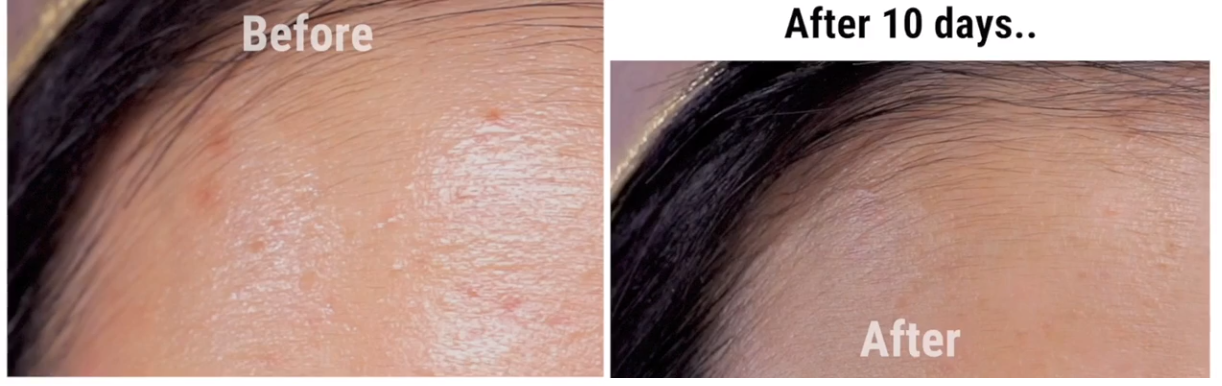 Nếu bạn đang khổ sở vì mụn đầu trắng thì đây chính là bí kíp nặn mụn chuẩn nhất dành cho bạn - Ảnh 10. Nếu bạn đang khổ sở vì mụn đầu trắng thì đây chính là bí kíp nặn mụn chuẩn nhất dành cho bạn - Ảnh 10.