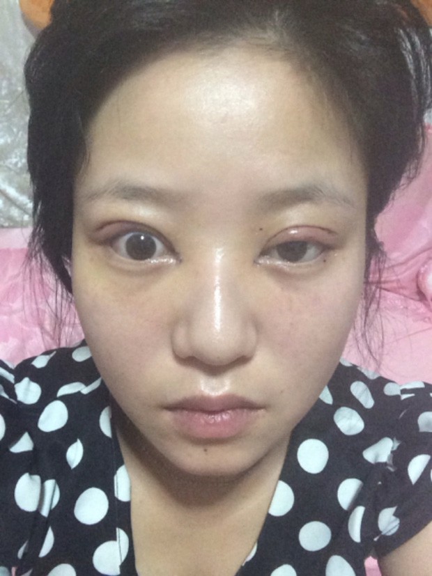Là tiểu phẫu nhưng cắt mí hay bóc mỡ bọng mắt cũng có thể gây ra những hậu quả nhìn kinh khủng như thế này - Ảnh 11. Là tiểu phẫu nhưng cắt mí hay bóc mỡ bọng mắt cũng có thể gây ra những hậu quả nhìn kinh khủng như thế này - Ảnh 11.