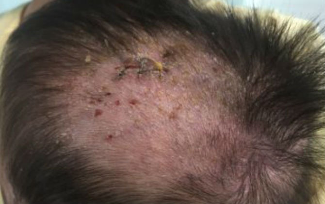 Trẻ bị chốc đầu đừng nghĩ là cứt trâu mà có thể mắc căn bệnh đáng sợ này - Ảnh 1. Trẻ bị chốc đầu đừng nghĩ là cứt trâu mà có thể mắc căn bệnh đáng sợ này - Ảnh 1.