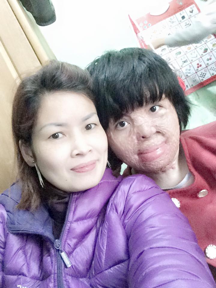 Cô gái bị chồng thiêu sống đúng mùng 2 Tết năm ngoái vẫn đang trên hành trình tìm lại hình hài - Ảnh 11. Cô gái bị chồng thiêu sống đúng mùng 2 Tết năm ngoái vẫn đang trên hành trình tìm lại hình hài - Ảnh 11.