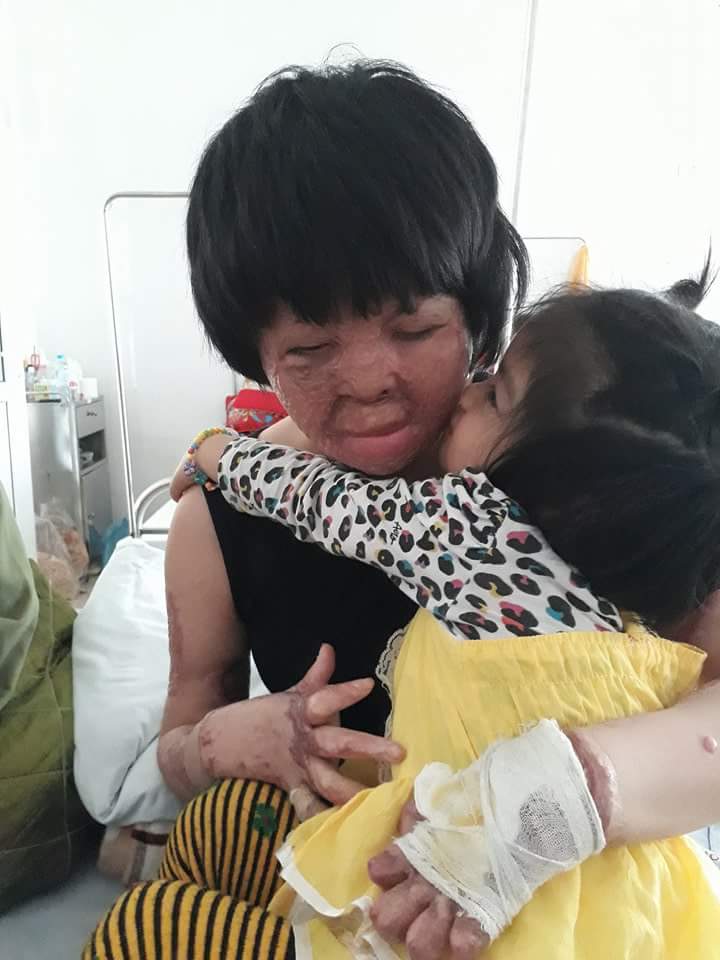 Cô gái bị chồng thiêu sống đúng mùng 2 Tết năm ngoái vẫn đang trên hành trình tìm lại hình hài - Ảnh 5. Cô gái bị chồng thiêu sống đúng mùng 2 Tết năm ngoái vẫn đang trên hành trình tìm lại hình hài - Ảnh 5.