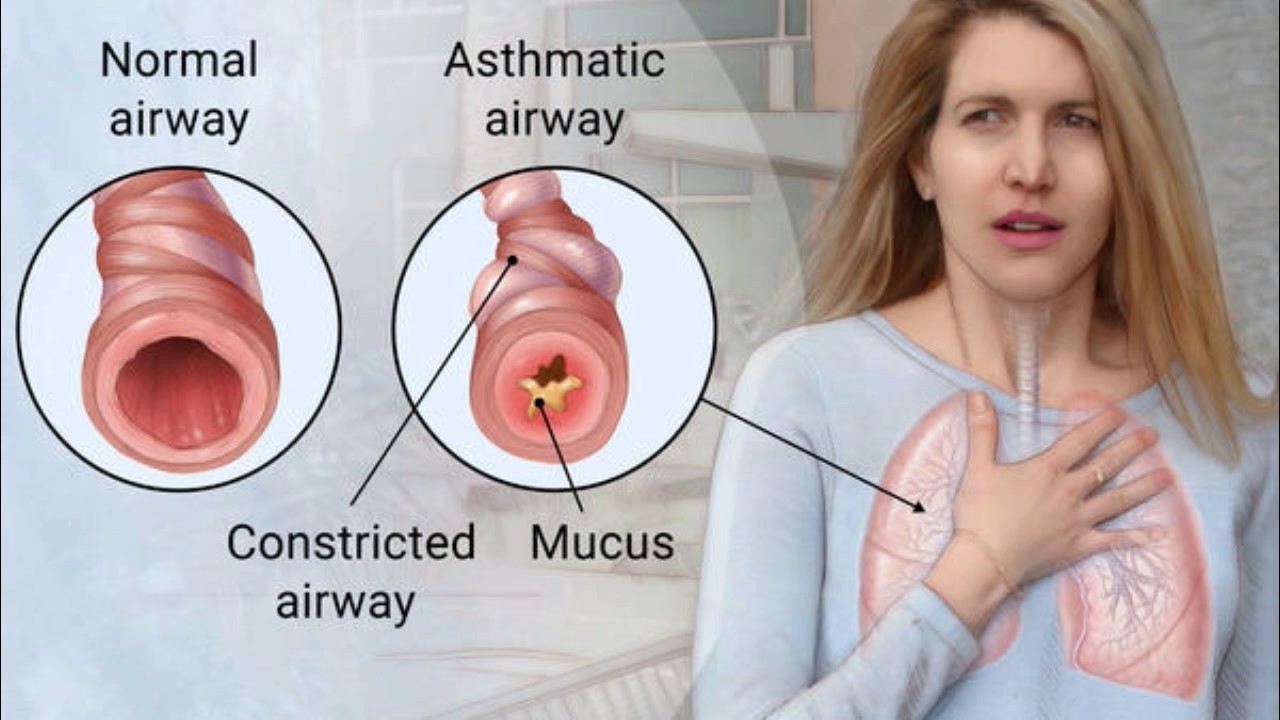 6 căn bệnh gây ra các cơn ho mãn tính - Ảnh 1. 6 căn bệnh gây ra các cơn ho mãn tính - Ảnh 1.