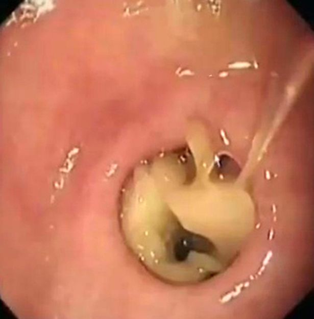 Chuyện lạ có thật: Cây nấm mọc dài 7cm trong bụng người phụ nữ - Ảnh 1.