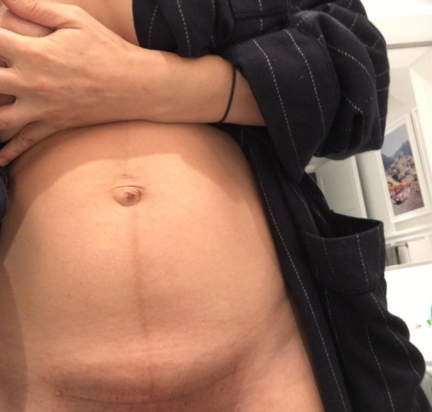 Khoe vết sẹo đẹp như một đường chỉ nhỏ xíu, bà mẹ đánh bay suy nghĩ sinh mổ thật đáng sợ - Ảnh 2. Khoe vết sẹo đẹp như một đường chỉ nhỏ xíu, bà mẹ đánh bay suy nghĩ sinh mổ thật đáng sợ - Ảnh 2.