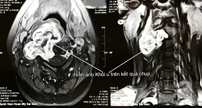 TP.HCM: Cô gái 26 tuổi suýt mất giọng nói vĩnh viễn vì mang khối u đặc biệt nhưng lầm là hạch ở cổ - Ảnh 1. TP.HCM: Cô gái 26 tuổi suýt mất giọng nói vĩnh viễn vì mang khối u đặc biệt nhưng lầm là hạch ở cổ - Ảnh 1.