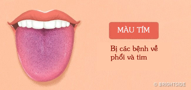 Bằng cách kiểm tra lưỡi mỗi ngày, rất có thể bạn sẽ phát hiện sớm những căn bệnh mình đang gặp phải - Ảnh 6.