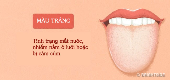 Bằng cách kiểm tra lưỡi mỗi ngày, rất có thể bạn sẽ phát hiện sớm những căn bệnh mình đang gặp phải - Ảnh 3.