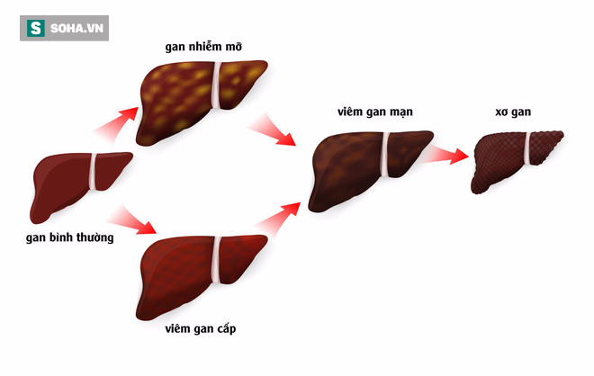 Những nhóm người cần phải chú ý chăm sóc gan, để muộn sẽ không kịp trở tay - Ảnh 1.