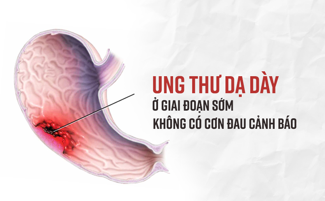 Phó giáo sư Mỹ chỉ rõ 6 dấu hiệu không gây đau nhưng cảnh báo sớm bệnh ung thư dạ dày - Ảnh 1.