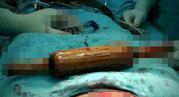 Kinh hoàng chồng nhét cả chày cán bột vào trong người vợ vì vô sinh - Ảnh 1. Kinh hoàng chồng nhét cả chày cán bột vào trong người vợ vì vô sinh - Ảnh 1.