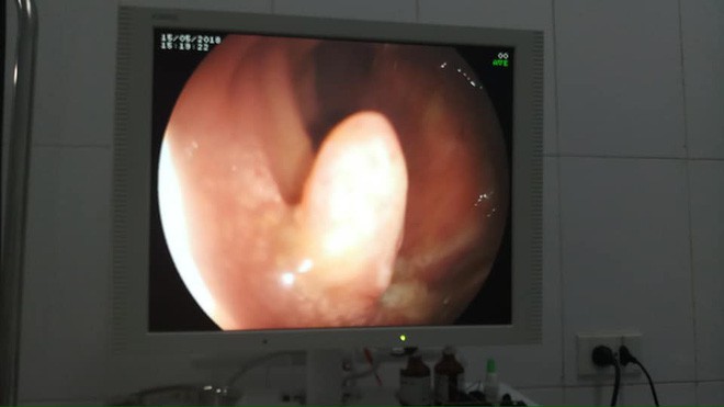 Trẻ 4 tuổi đã phải phẫu thuật polyp ở ruột già: BS cảnh báo dấu hiệu bệnh qua đại tiện - Ảnh 1. Trẻ 4 tuổi đã phải phẫu thuật polyp ở ruột già: BS cảnh báo dấu hiệu bệnh qua đại tiện - Ảnh 1.