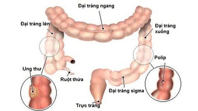 5 dấu hiệu điển hình cảnh báo khối u ung thư đại trực tràng đang phát triển thần tốc - Ảnh 3. 5 dấu hiệu điển hình cảnh báo khối u ung thư đại trực tràng đang phát triển thần tốc - Ảnh 3.
