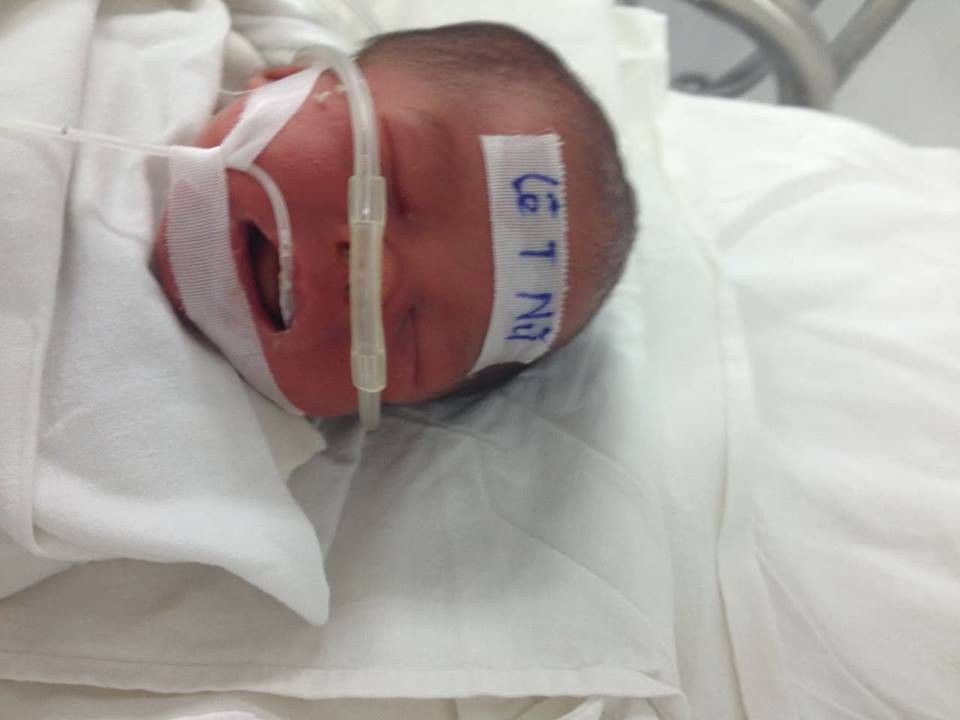 Hành trình hồi phục kì diệu của cặp song sinh chào đời chỉ nặng 1.7kg, trải qua 3 lần cấp cứu tưởng không qua khỏi - Ảnh 3. Hành trình hồi phục kì diệu của cặp song sinh chào đời chỉ nặng 1.7kg, trải qua 3 lần cấp cứu tưởng không qua khỏi - Ảnh 3.