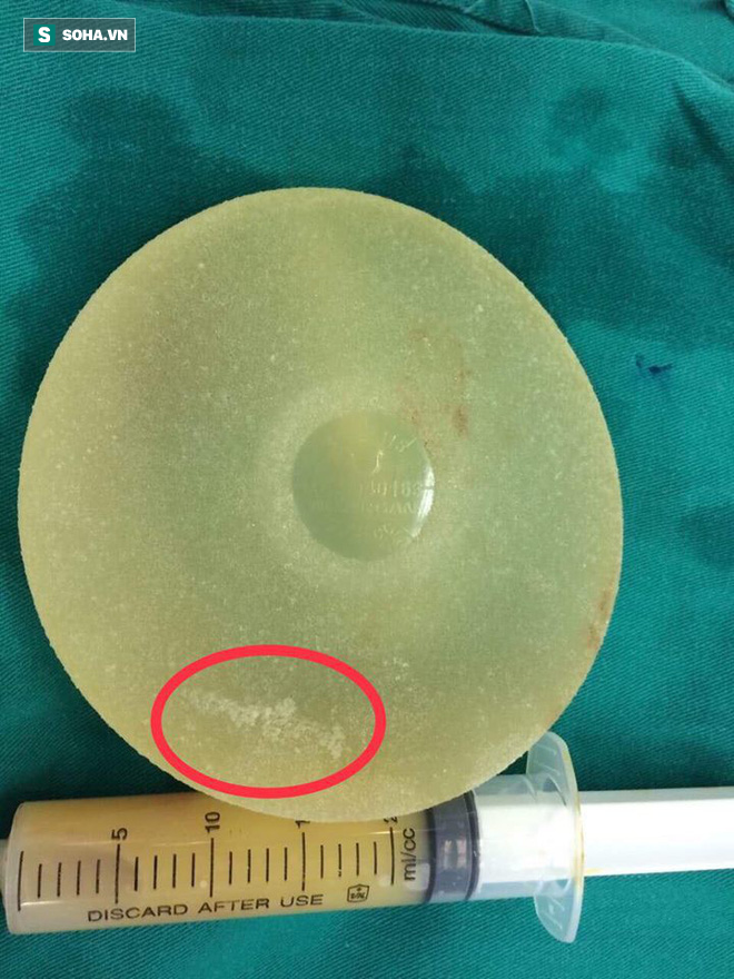 Vụ ca sĩ Ivy Trần nổ ngực trên máy bay: Bác sĩ thẩm mỹ lý giải nguyên nhân thực tế - Ảnh 1. Vụ ca sĩ Ivy Trần nổ ngực trên máy bay: Bác sĩ thẩm mỹ lý giải nguyên nhân thực tế - Ảnh 1.