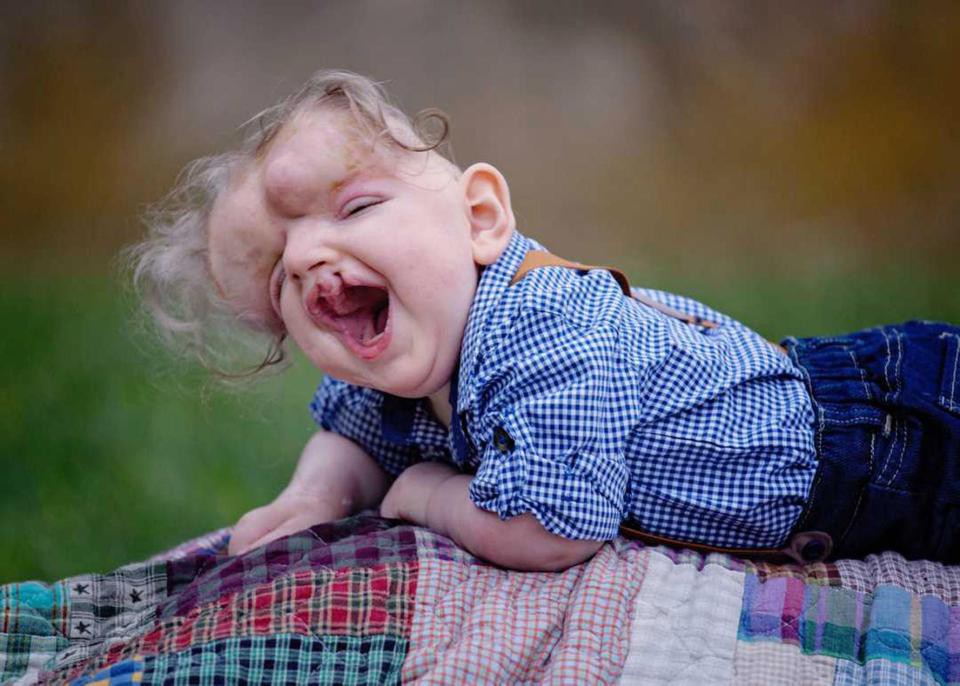 Sinh ra không có hộp sọ, cứ tưởng bé trai này sẽ không qua khỏi, nhưng rồi kỳ tích đã xảy ra - Ảnh 1. Sinh ra không có hộp sọ, cứ tưởng bé trai này sẽ không qua khỏi, nhưng rồi kỳ tích đã xảy ra - Ảnh 1.