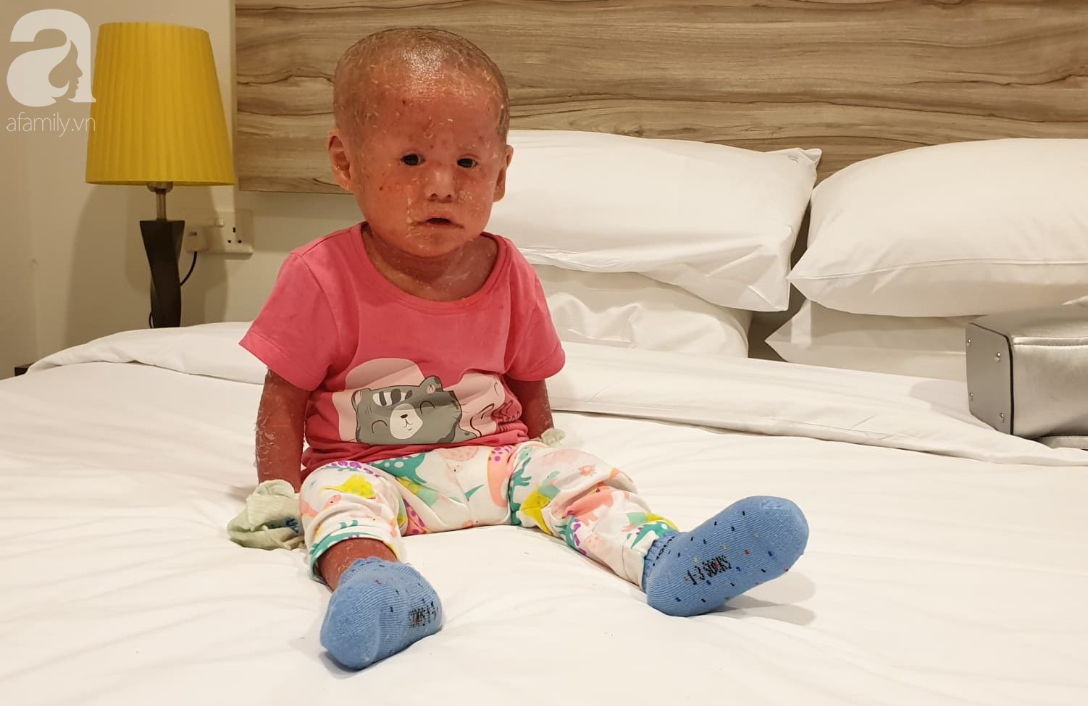 Hình ảnh mới nhất của bé Bích bị bỏ rơi, người đầy vẩy ngứa như da trăn sau đợt khám bệnh đầu tiên tại Singapore - Ảnh 4.
