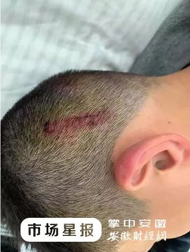 Đi trễ 2 ph&uacute;t, cậu b&eacute; bi gi&aacute;o vi&ecirc;n đ&aacute;nh bằng 4 c&acirc;y chổi, nh&igrave;n ảnh thương t&iacute;ch cư d&acirc;n mạng tức giận: Gi&aacute;o vi&ecirc;n kh&ocirc;ng phải con người - Ảnh 2.