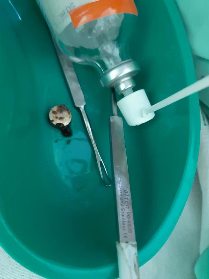 Con gái kêu đau đầu, mẹ nghi con bị dị ứng, tự tiện mua thuốc giảm đau nhưng rồi ngã quỵ khi bác sĩ lấy ra thứ kinh dị này - Ảnh 5. Con gái kêu đau đầu, mẹ nghi con bị dị ứng, tự tiện mua thuốc giảm đau nhưng rồi ngã quỵ khi bác sĩ lấy ra thứ kinh dị này - Ảnh 5.