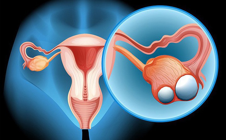 Đây là 6 căn bệnh ung thư mà người thừa cân có nguy cơ mắc phải rất cao - Ảnh 3. Đây là 6 căn bệnh ung thư mà người thừa cân có nguy cơ mắc phải rất cao - Ảnh 3.