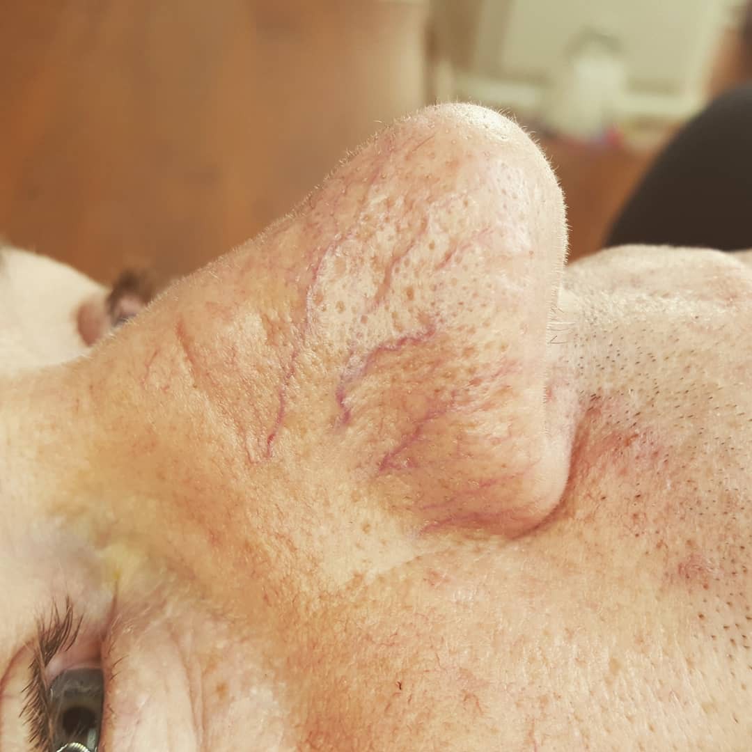 Da nổi gân máu li ti là nỗi niềm “dai dẳng” của nhiều chị em, nhưng không hẳn đã hết cách giải quyết chúng - Ảnh 2. Da nổi gân máu li ti là nỗi niềm “dai dẳng” của nhiều chị em, nhưng không hẳn đã hết cách giải quyết chúng - Ảnh 2.