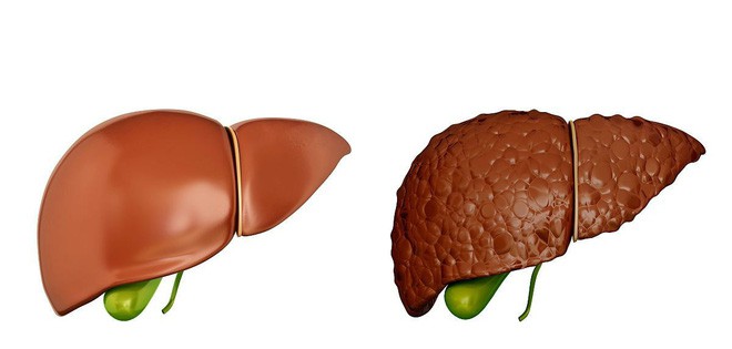 Khi có sự thay đổi này xảy ra ở ngực: 90% khả năng bạn đã bị xơ gan, hãy nhanh đi khám - Ảnh 2. Khi có sự thay đổi này xảy ra ở ngực: 90% khả năng bạn đã bị xơ gan, hãy nhanh đi khám - Ảnh 2.