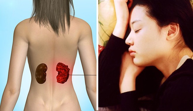 Ung thư thận: không can thiệp sớm thì chỉ sống được khoảng 1 năm và đây là 3 dấu hiệu nhận biết điển hình - Ảnh 3. Ung thư thận: không can thiệp sớm thì chỉ sống được khoảng 1 năm và đây là 3 dấu hiệu nhận biết điển hình - Ảnh 3.