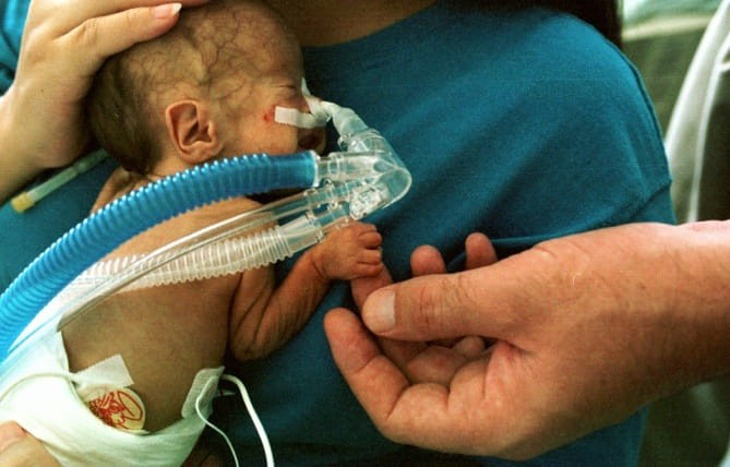Nhiễm độc sữa mẹ được hút ra từ máy hút sữa, bé sơ sinh mắc bệnh viêm màng não hiếm gặp - Ảnh 1. Nhiễm độc sữa mẹ được hút ra từ máy hút sữa, bé sơ sinh mắc bệnh viêm màng não hiếm gặp - Ảnh 1.