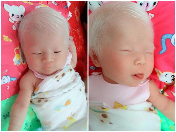 Sinh con có mái tóc trắng như cước, mẹ hí hửng đi khoe, không ngờ con mắc bệnh nguy hiểm - Ảnh 20. Sinh con có mái tóc trắng như cước, mẹ hí hửng đi khoe, không ngờ con mắc bệnh nguy hiểm - Ảnh 20.