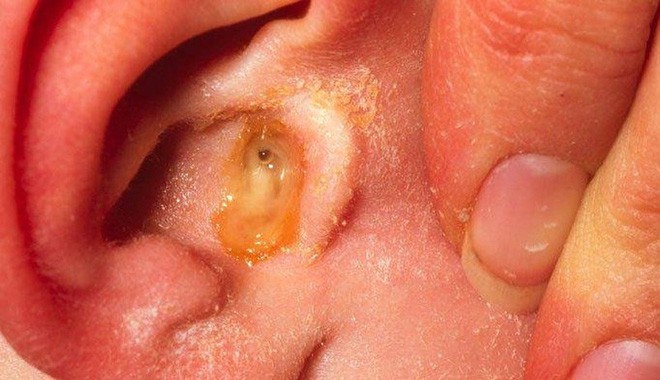 Viêm tai giữa cơn ác mộng của cha mẹ có con nhỏ: 3 sai lầm khiến bệnh càng thêm nặng - Ảnh 1. Viêm tai giữa cơn ác mộng của cha mẹ có con nhỏ: 3 sai lầm khiến bệnh càng thêm nặng - Ảnh 1.