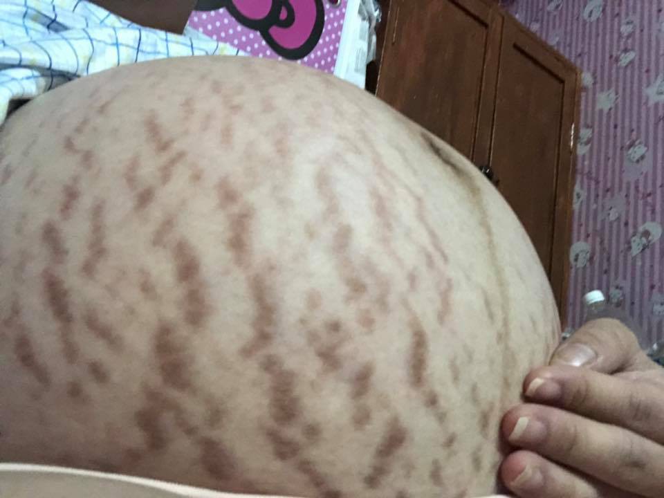 Mẹ trẻ than thở bụng bầu rạn như dưa bở, nhưng đáng sợ là ảnh sau sinh được chị em chia sẻ thêm - Ảnh 1. Mẹ trẻ than thở bụng bầu rạn như dưa bở, nhưng đáng sợ là ảnh sau sinh được chị em chia sẻ thêm - Ảnh 1.