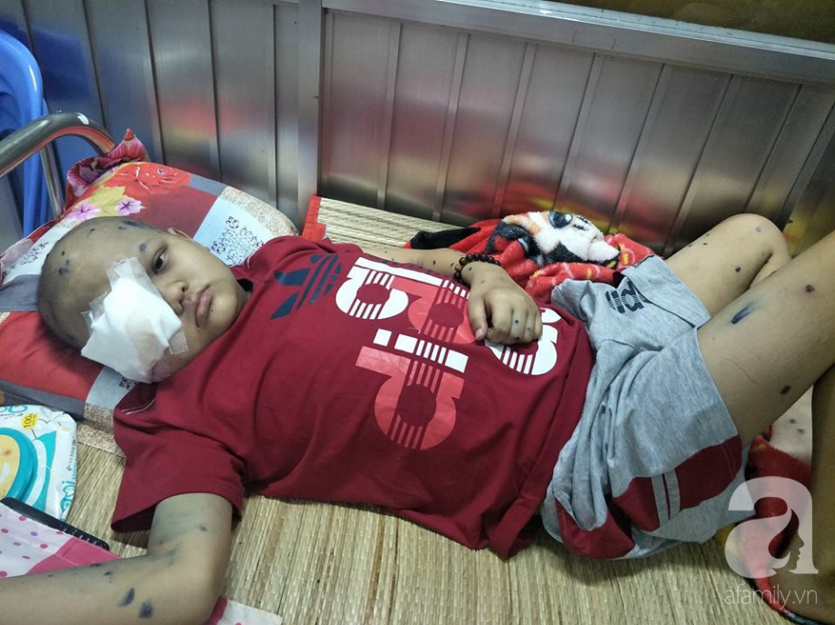 Mắt bất ngờ sưng to, bé trai mang bệnh ung thư: Cảnh báo căn bệnh 80% người mắc bị tái phát sau điều trị - Ảnh 1. Mắt bất ngờ sưng to, bé trai mang bệnh ung thư: Cảnh báo căn bệnh 80% người mắc bị tái phát sau điều trị - Ảnh 1.