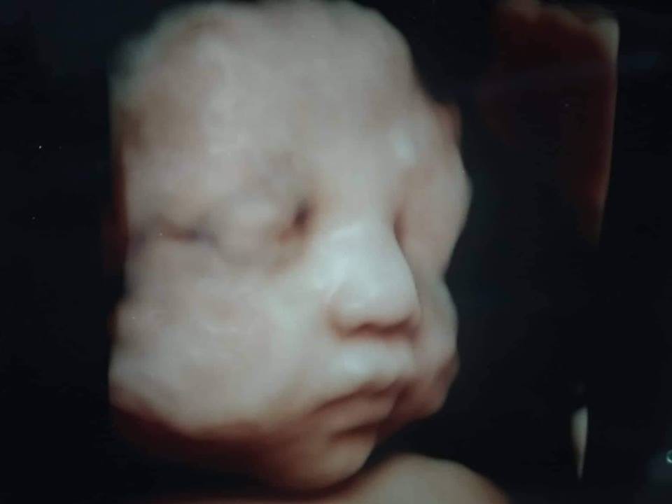 Hành trình giữ con kì diệu của mẹ Hà Nội khi thai nhi bị tràn dịch màng phổi, màng bụng và phù thai - Ảnh 3. Hành trình giữ con kì diệu của mẹ Hà Nội khi thai nhi bị tràn dịch màng phổi, màng bụng và phù thai - Ảnh 3.