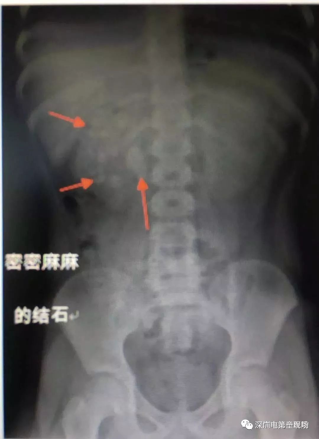 Cậu bé 9 tuổi có hơn 50 viên sỏi trong thận, nguyên nhân không ngờ là từ chính thói quen ăn uống này - Ảnh 1. Cậu bé 9 tuổi có hơn 50 viên sỏi trong thận, nguyên nhân không ngờ là từ chính thói quen ăn uống này - Ảnh 1.