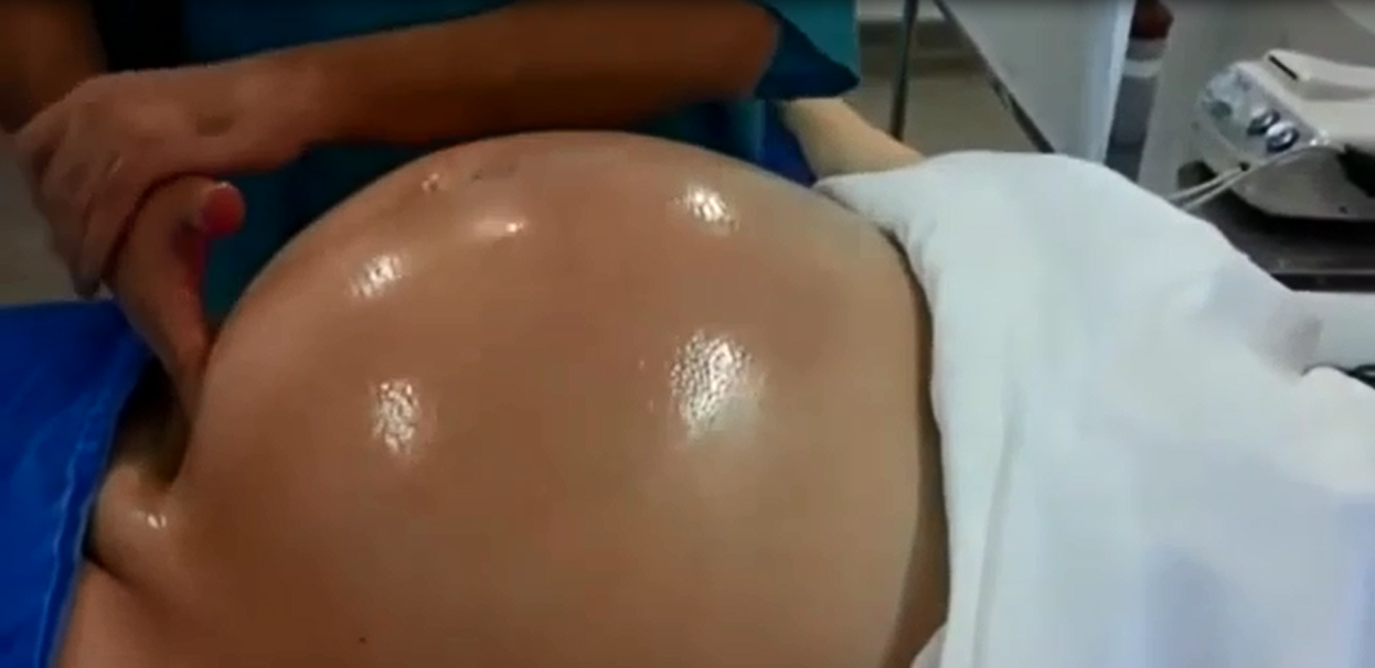 Tròn mắt xem bác sĩ dùng 2 tay xoay ngôi thai từ ngôi ngược thành ngôi thuận chỉ trong chưa đầy 1 phút - Ảnh 2. Tròn mắt xem bác sĩ dùng 2 tay xoay ngôi thai từ ngôi ngược thành ngôi thuận chỉ trong chưa đầy 1 phút - Ảnh 2.
