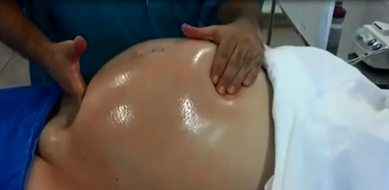 Tròn mắt xem bác sĩ dùng 2 tay xoay ngôi thai từ ngôi ngược thành ngôi thuận chỉ trong chưa đầy 1 phút - Ảnh 3. Tròn mắt xem bác sĩ dùng 2 tay xoay ngôi thai từ ngôi ngược thành ngôi thuận chỉ trong chưa đầy 1 phút - Ảnh 3.