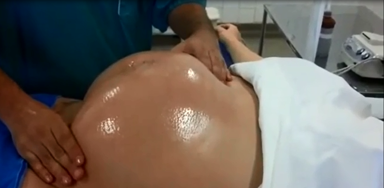 Tròn mắt xem bác sĩ dùng 2 tay xoay ngôi thai từ ngôi ngược thành ngôi thuận chỉ trong chưa đầy 1 phút - Ảnh 4. Tròn mắt xem bác sĩ dùng 2 tay xoay ngôi thai từ ngôi ngược thành ngôi thuận chỉ trong chưa đầy 1 phút - Ảnh 4.