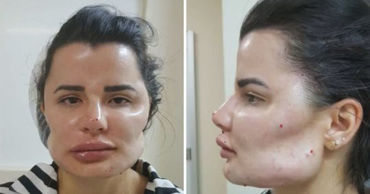 H&agrave;ng chục người bị biến dạng khu&ocirc;n mặt kh&ocirc;ng thể phục hồi, nhiều người bị trầm cảm v&igrave; sai lầm n&agrave;y của một b&aacute;c sĩ - Ảnh 3.