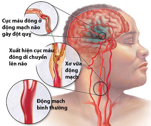 Phòng ngừa đột quỵ não khi trời lạnh giá - Ảnh 1.