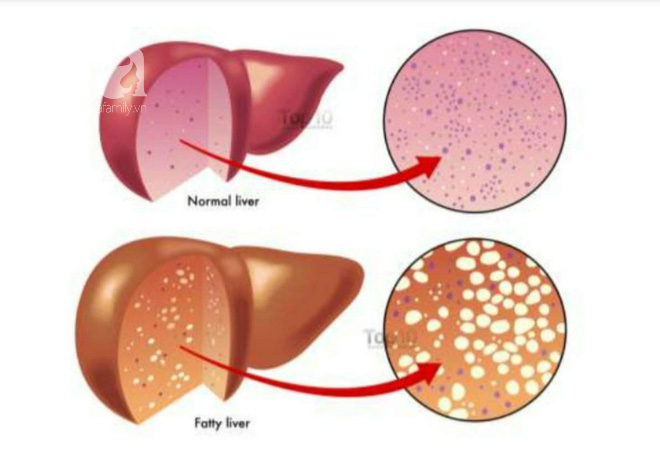 Cẩn thận mắc bệnh gan nhiễm mỡ vì uống rượu quá nhiều, nhậu đói ngày Tết - Ảnh 1.