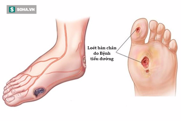 3 cách ngăn chặn và điều trị bệnh tiểu đường: Liệu pháp căn bản ai cũng nên áp dụng trước - Ảnh 2.